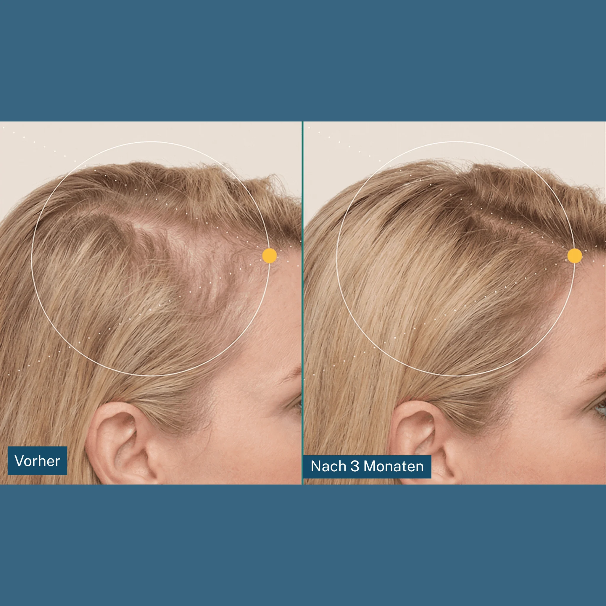 Dermastamp für die Kopfhaut - Image 3